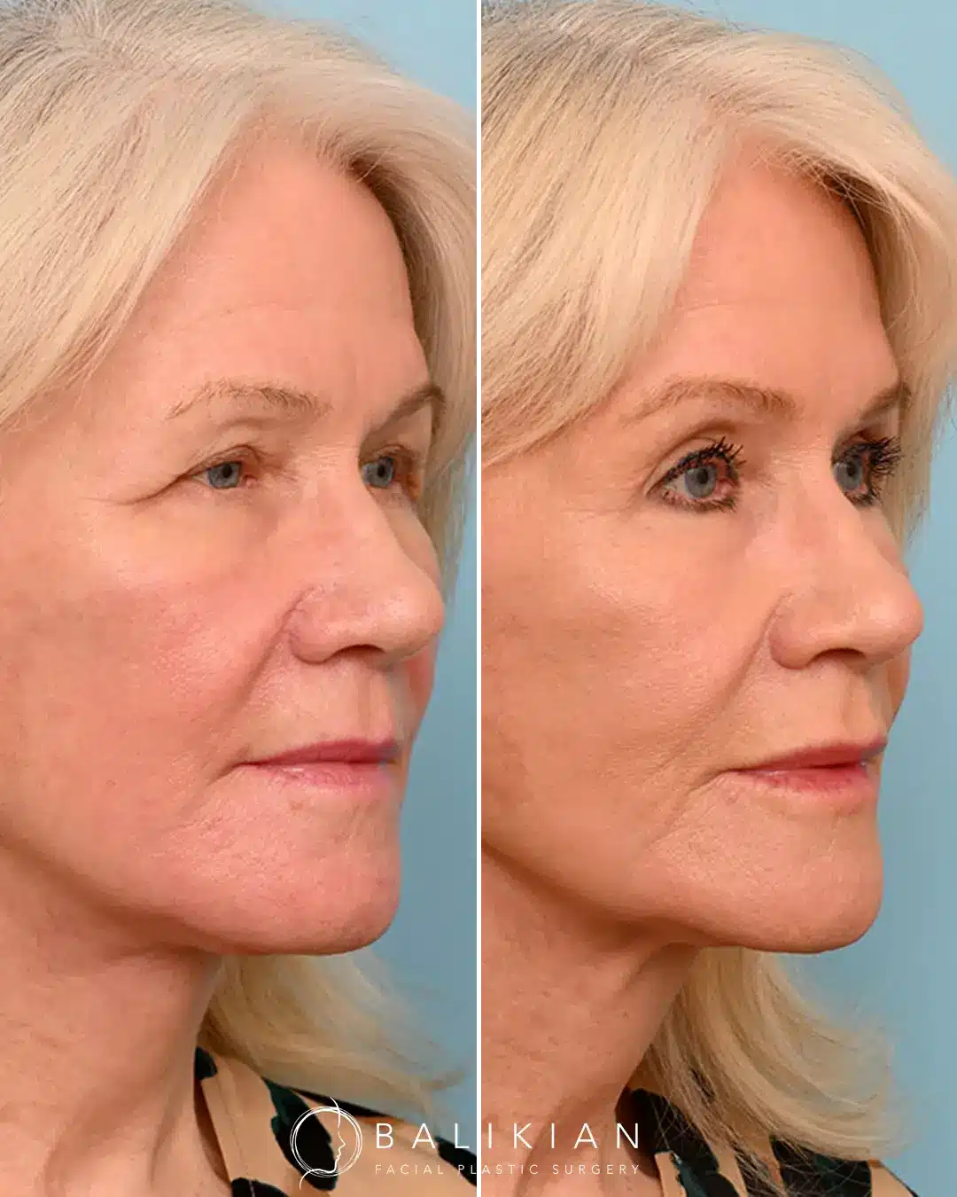 Facial fat grafting before and after with plumper cheeks and smoother skin