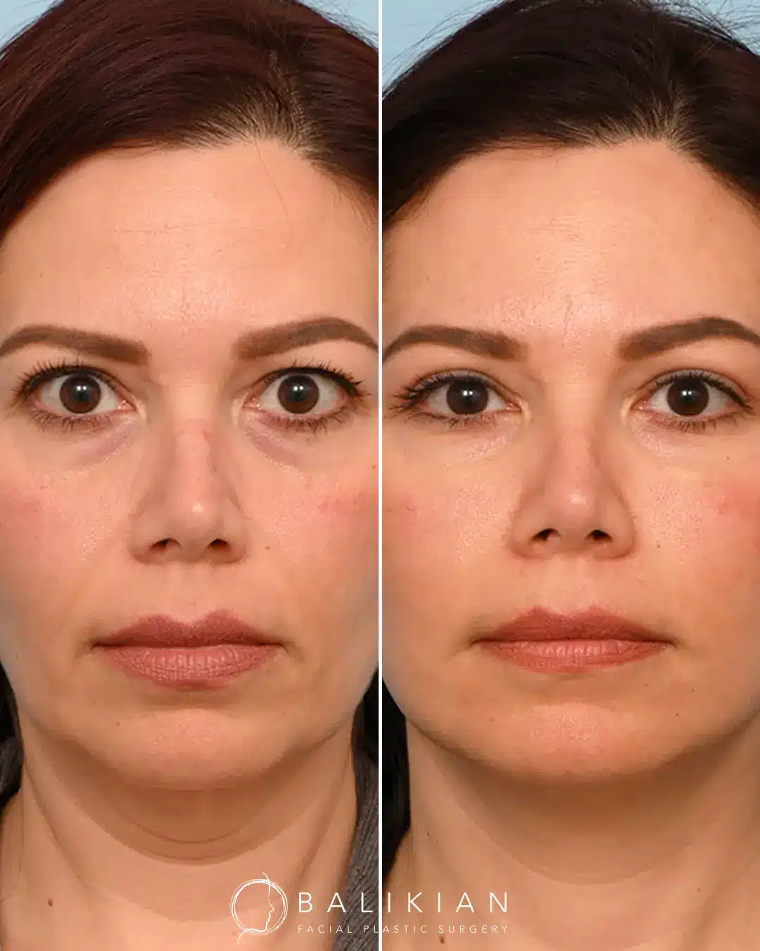 Before and after of facial fat transfer for lower eyelid hollow correction