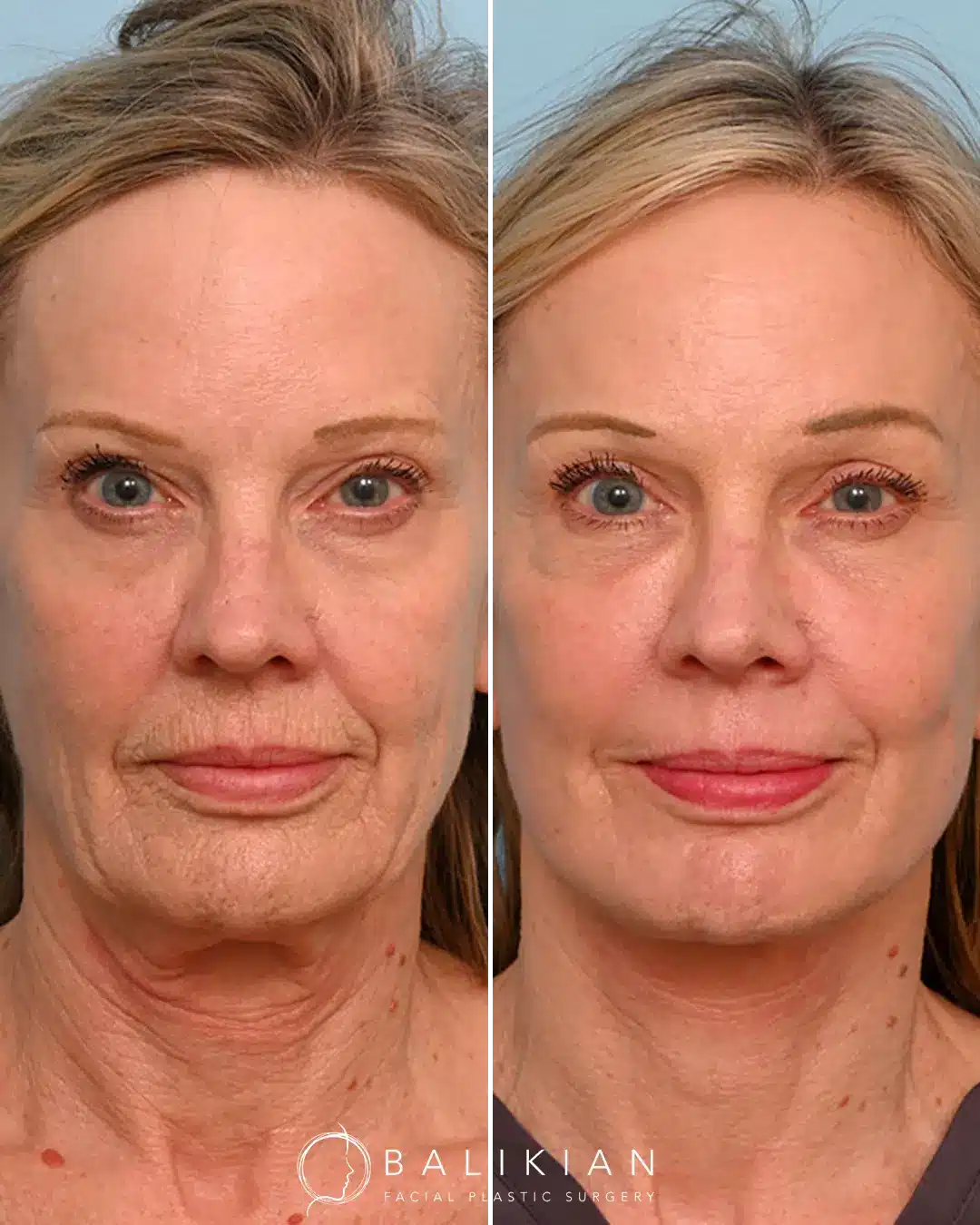 Facial fat grafting before and after highlighting softened nasolabial folds