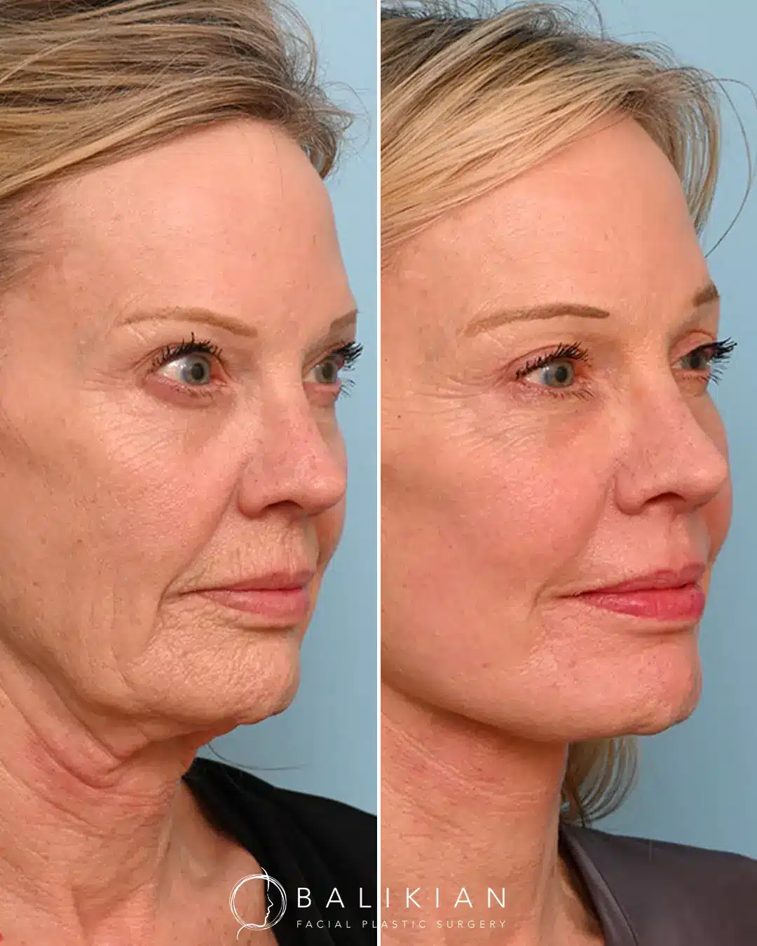 Fat transfer to face before and after photos showing fuller midface