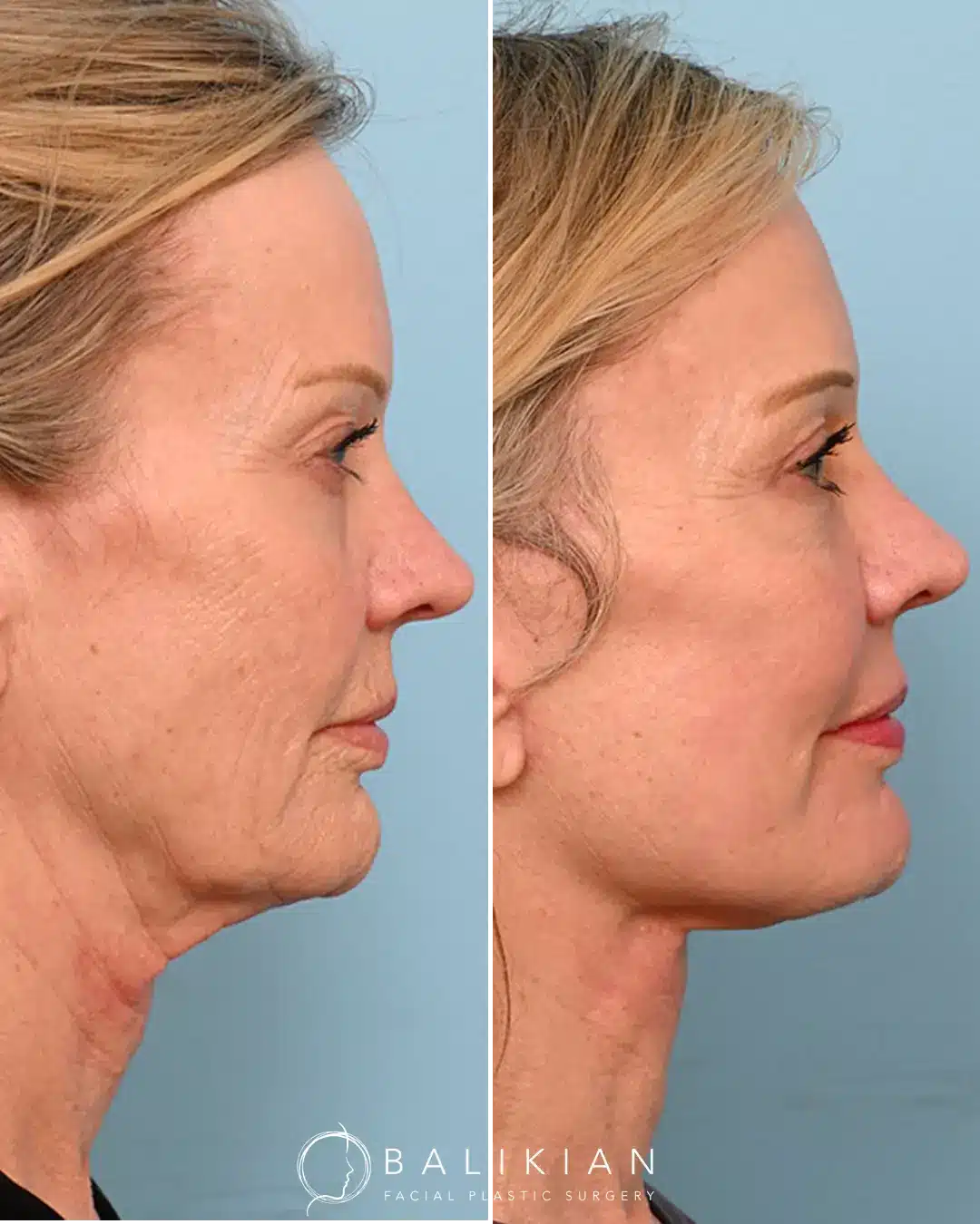 Before and after fat grafting to face with improved facial contours