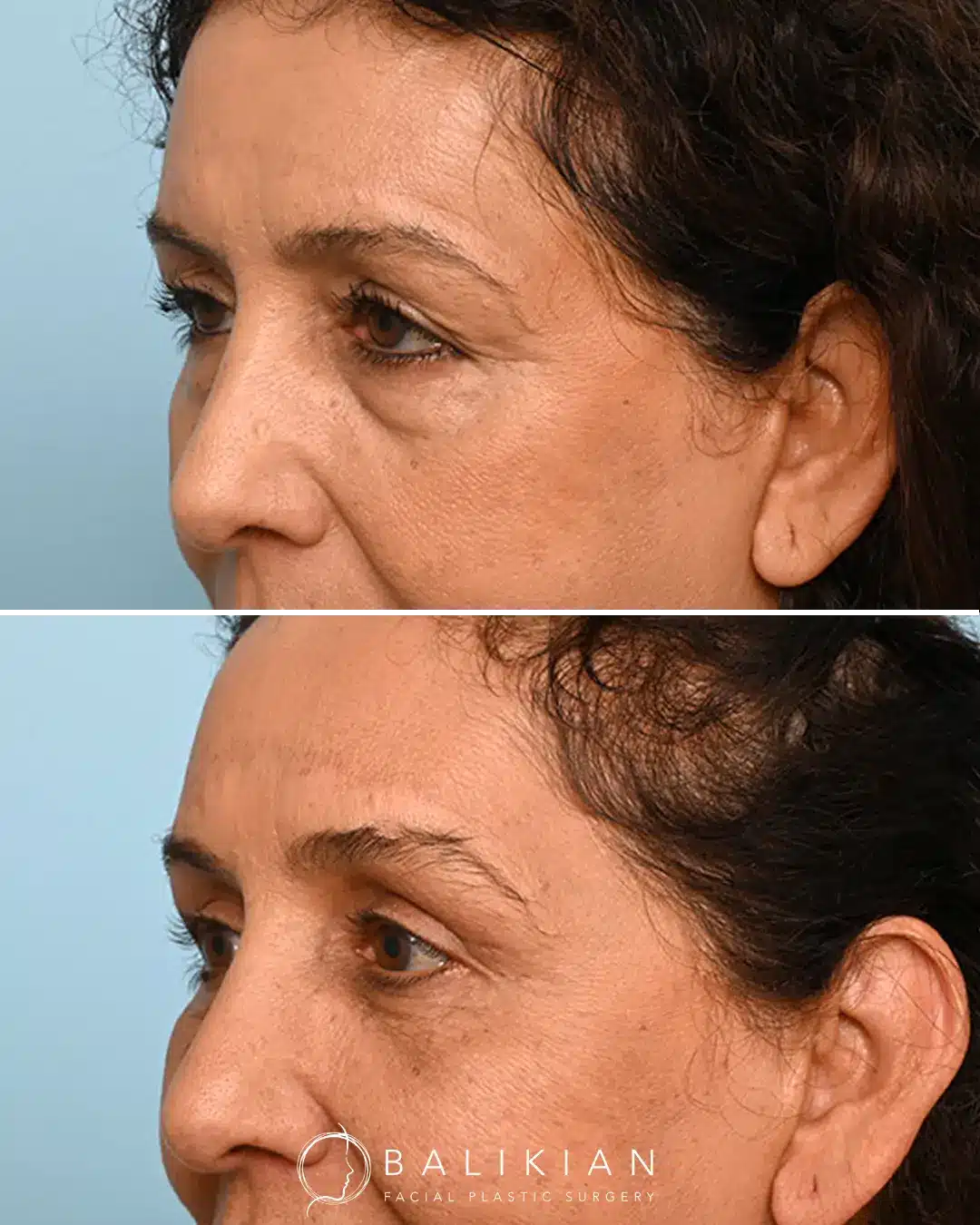 Fat transfer to under-eyes and cheeks before and after comparison