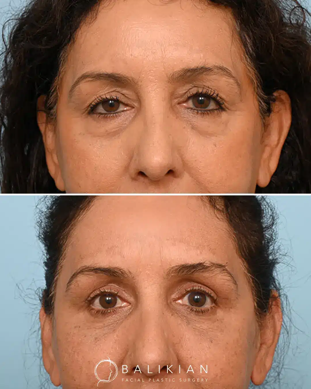 Facial fat grafting before and after with enhanced facial symmetry