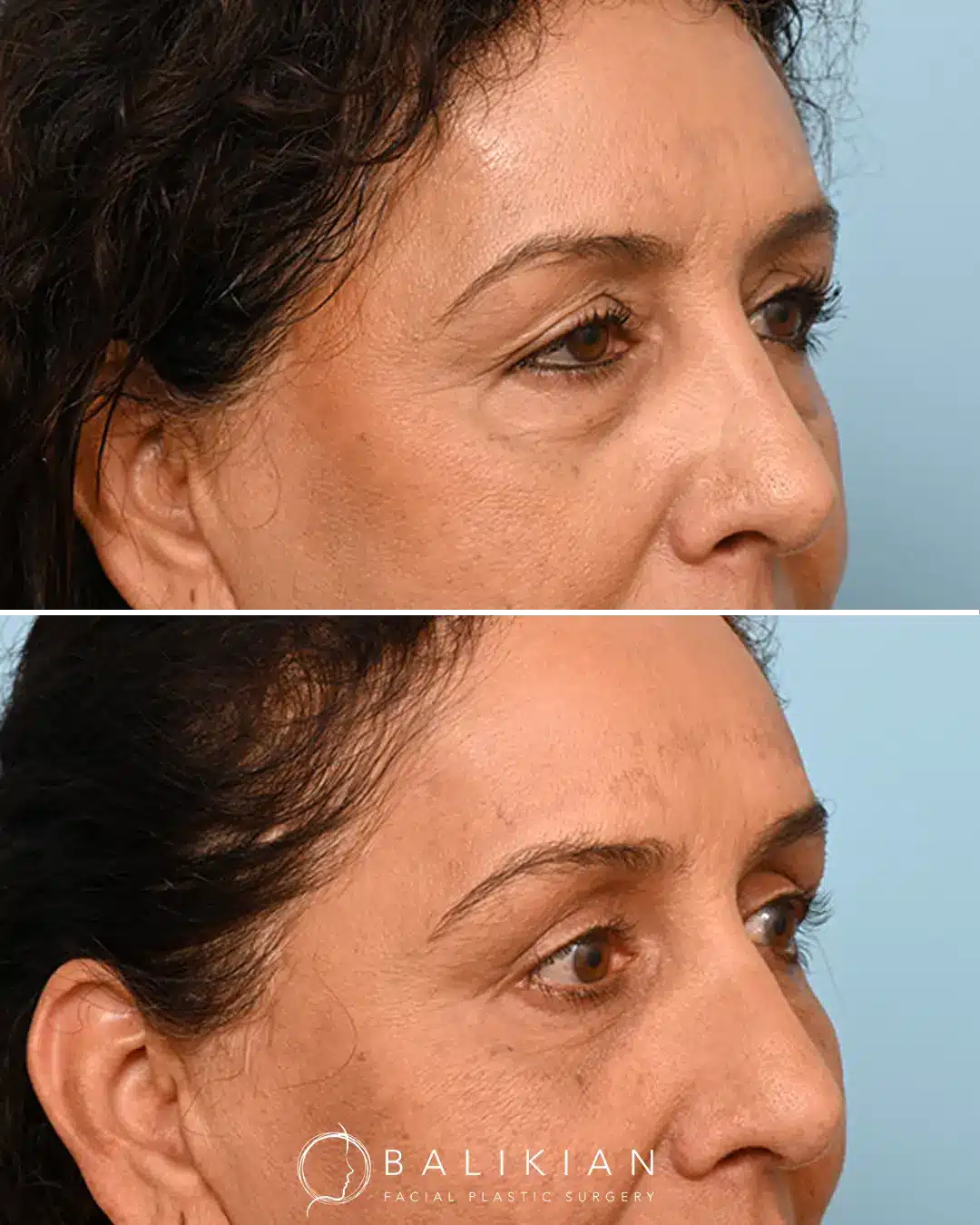 Before and after photos showing youthful fullness from facial fat injections