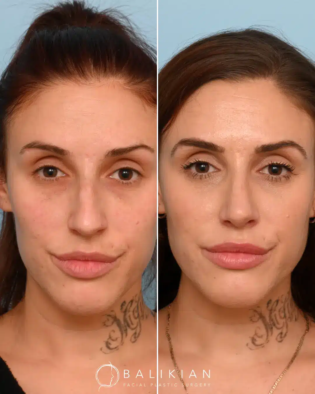 It’s always a privilege to help someone achieve their aesthetic goals and boost their confidence. Recovery is a journey, and I’m proud of my patient’s commitment to the healing process. Every patient deserves personalized care and attention, and it’s rewarding to see their confidence blossom as swelling subsides and results reveal themselves.