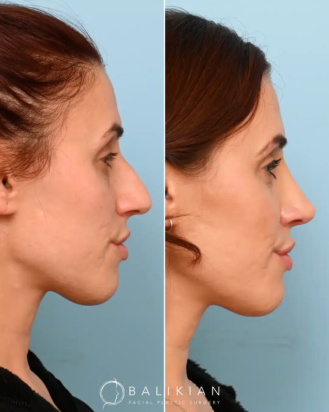 It’s always a privilege to help someone achieve their aesthetic goals and boost their confidence. Recovery is a journey, and I’m proud of my patient’s commitment to the healing process. Every patient deserves personalized care and attention, and it’s rewarding to see their confidence blossom as swelling subsides and results reveal themselves.