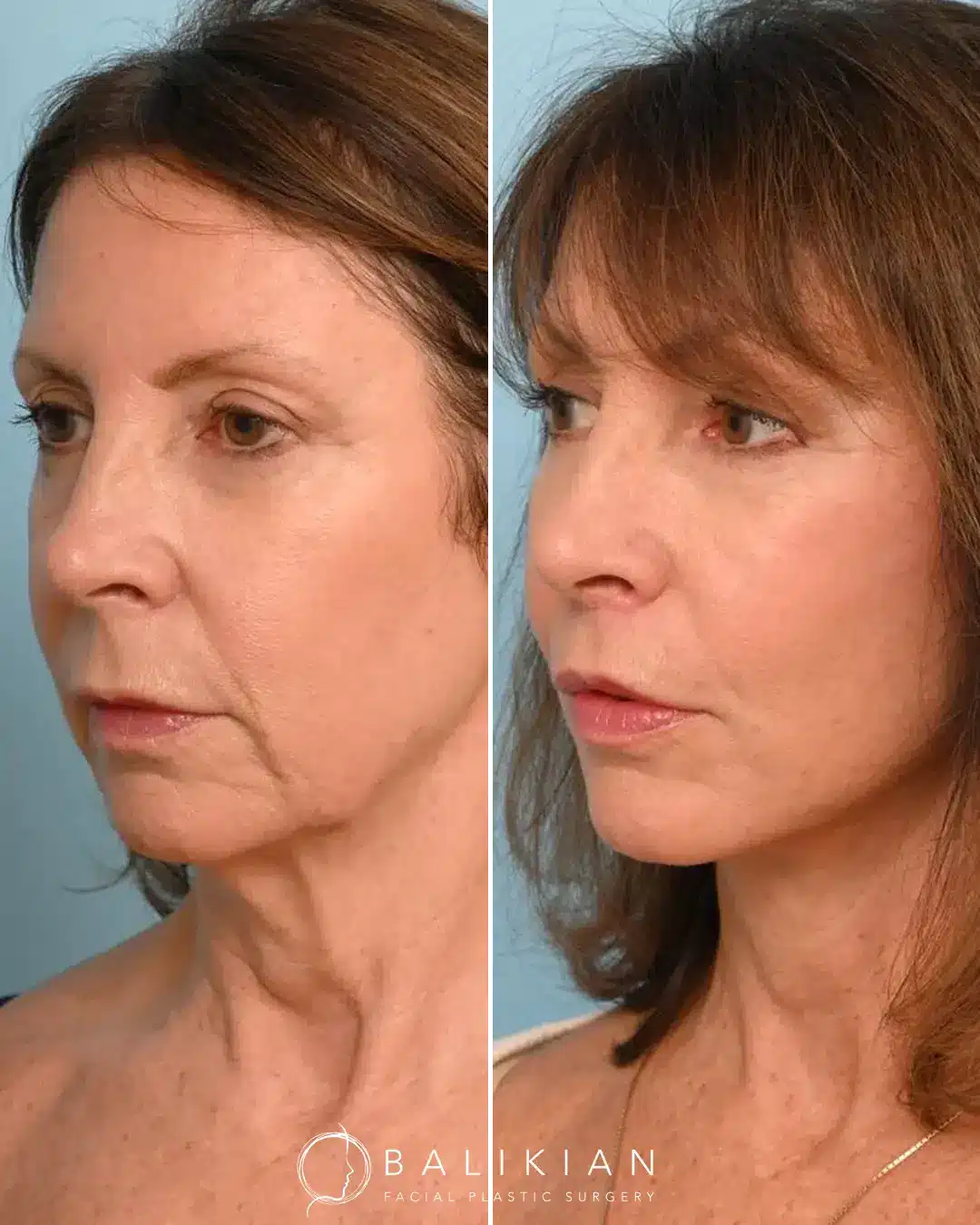 Improved skin texture and reduced fine lines from CO2 laser treatment
