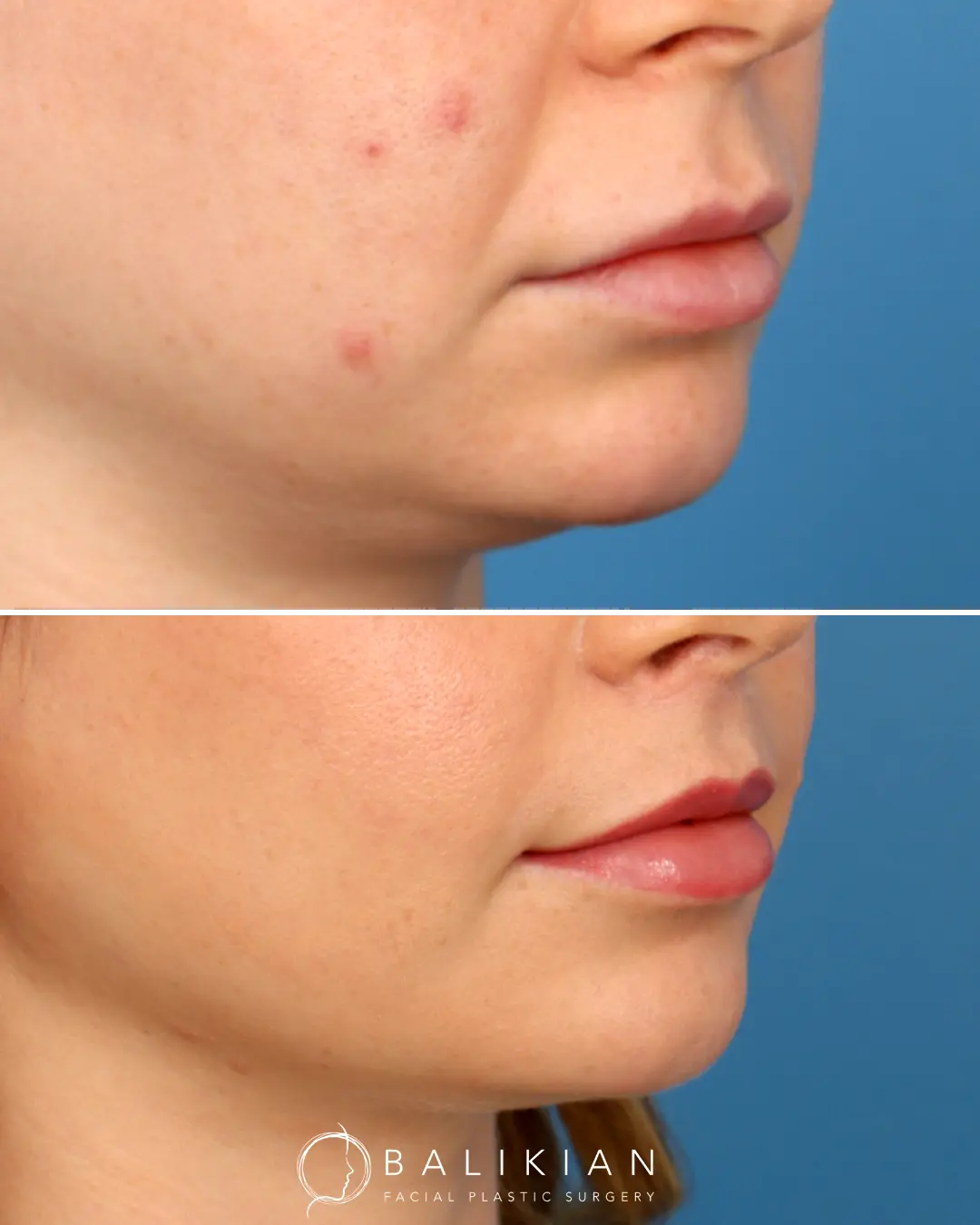 This angled view shows improved volume and shape of the upper lip after a lip lift. The procedure lifted the upper lip into a more ideal position, creating a harmonious transition between the nose, lips, and chin.
