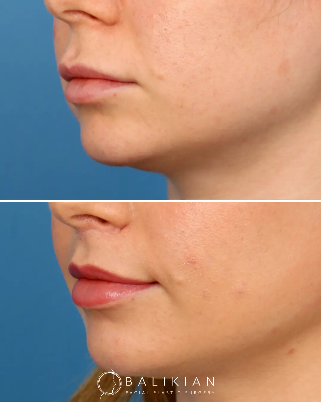 This patient underwent a lip lift to reduce the distance between the nose and upper lip, creating a more defined Cupid’s bow and enhanced lip curvature. The result is a naturally fuller-looking upper lip that complements her facial proportions and softens her expression.