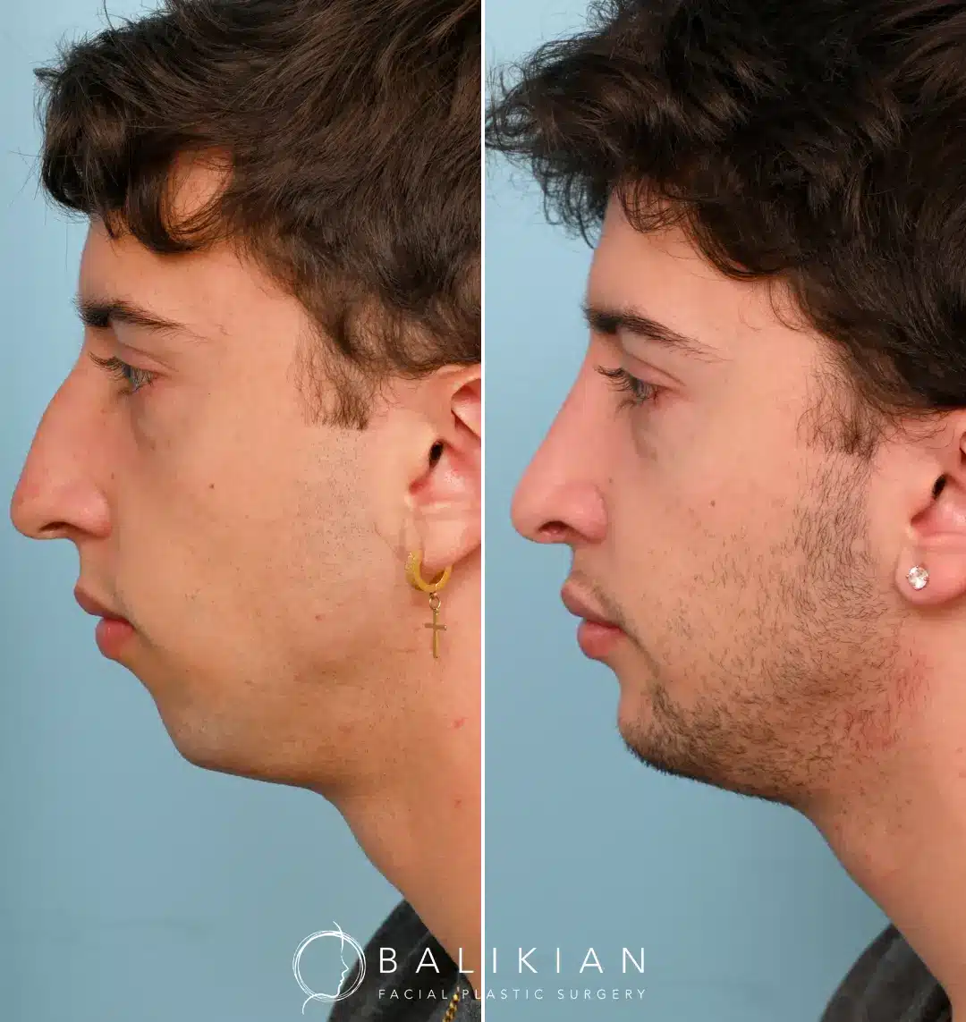 ide-by-side profile images of a male patient before and after primary Level II rhinoplasty and chin implant, highlighting a more balanced facial profile and defined chin