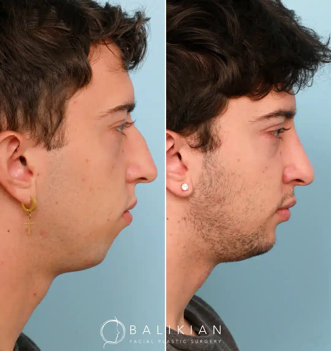 Before and after photo of a male patient who underwent external rhinoplasty and chin implant surgery, showing improved nasal contour and enhanced jawline projection