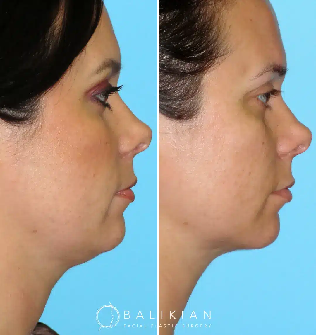 Defined jawline from neck liposuction