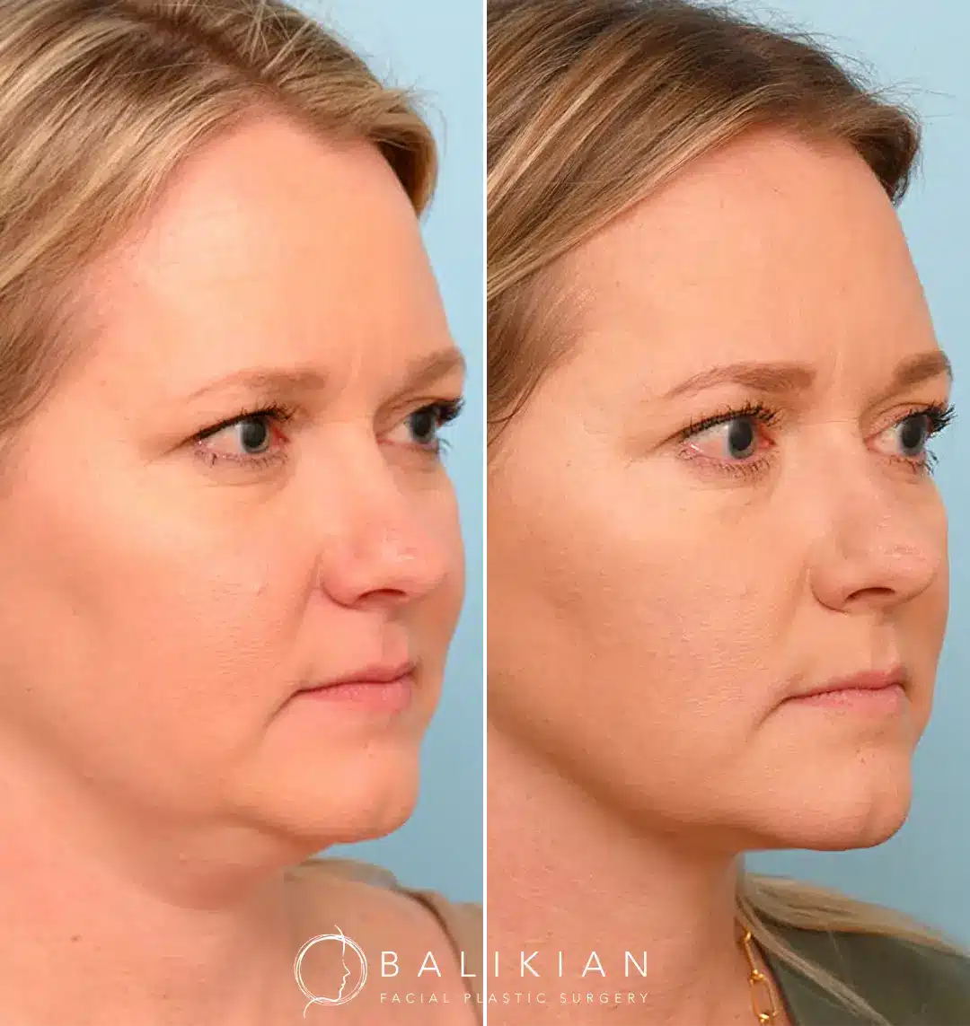 Neck liposuction for youthful profile