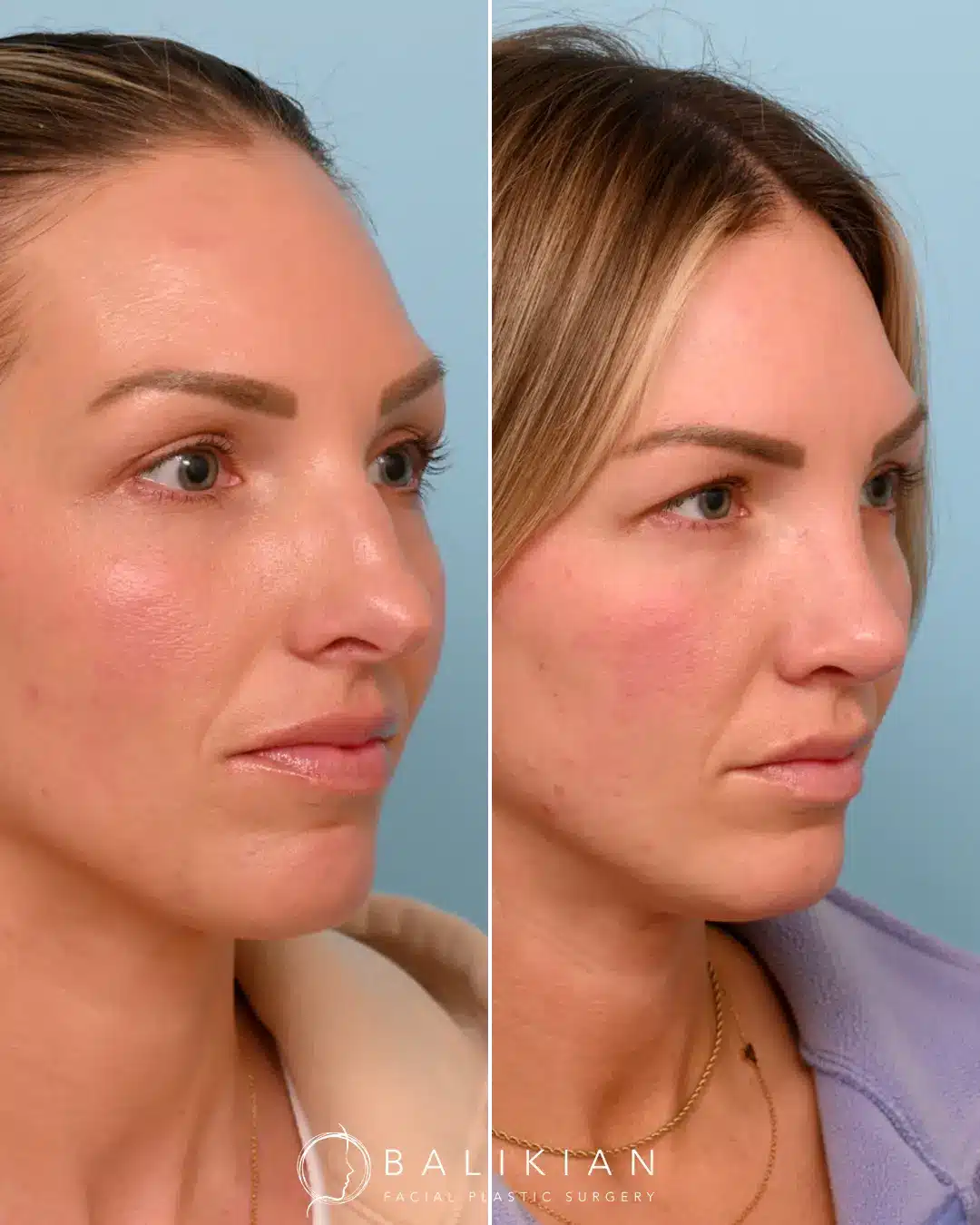 As a surgeon, Dr. Balikian is honored to help his patients align their outer appearance with their inner confidence and vision. Dr. Balikian performed an external rhinoplasty with septoplasty only three months ago. Her swelling will continue to subside over the year.
