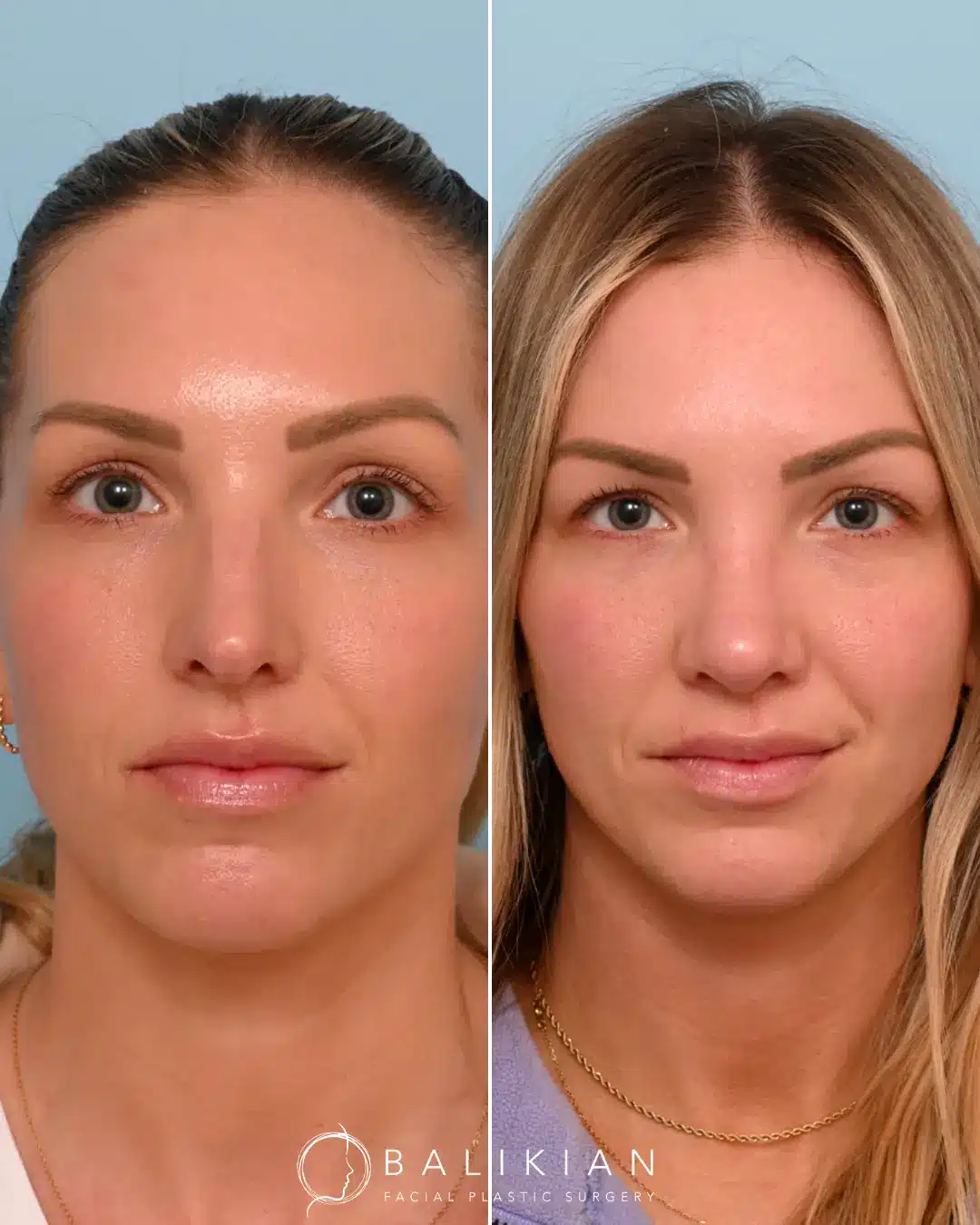 As a surgeon, Dr. Balikian is honored to help his patients align their outer appearance with their inner confidence and vision. Dr. Balikian performed an external rhinoplasty with septoplasty only three months ago. Her swelling will continue to subside over the year.