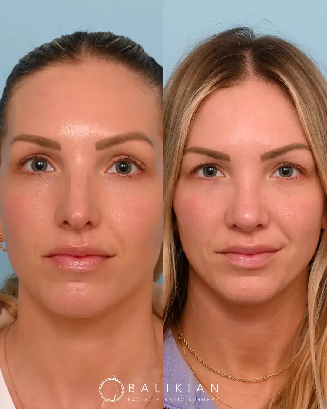 As a surgeon, Dr. Balikian is honored to help his patients align their outer appearance with their inner confidence and vision. Dr. Balikian performed an external rhinoplasty with septoplasty only three months ago. Her swelling will continue to subside over the year.