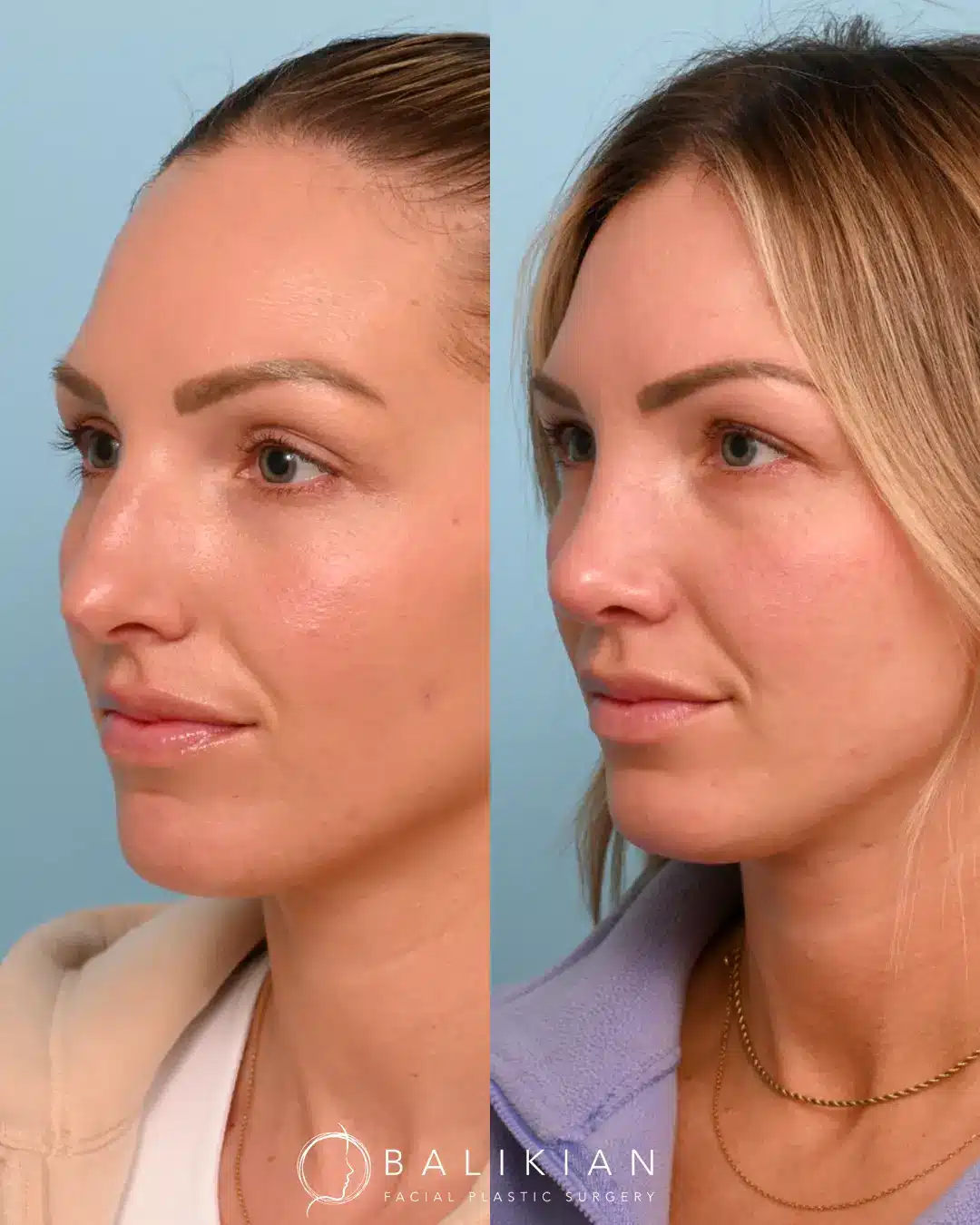 As a surgeon, Dr. Balikian is honored to help his patients align their outer appearance with their inner confidence and vision. Dr. Balikian performed an external rhinoplasty with septoplasty only three months ago. Her swelling will continue to subside over the year.