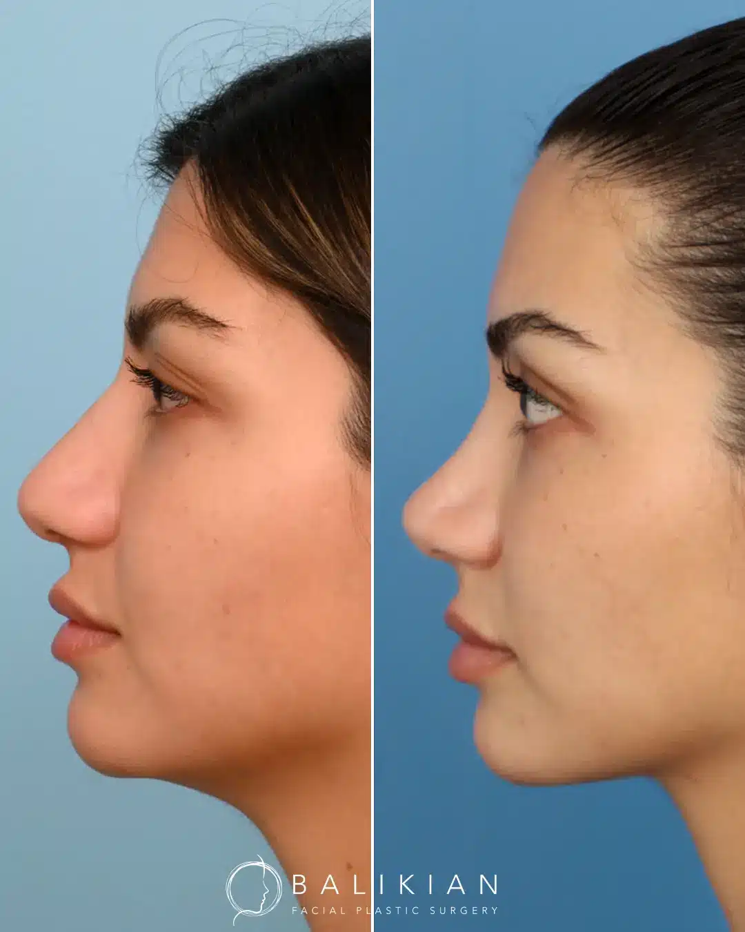 A rhinoplasty that just enhances your natural beauty and features. Dr. Balikian focuses on making your nose fit uniquely to your face and nothing makes him happier than helping his patients achieve their goals to still looking like themselves, but only softer.
