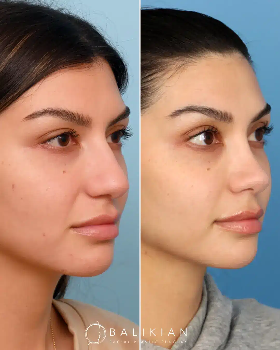 A rhinoplasty that just enhances your natural beauty and features. Dr. Balikian focuses on making your nose fit uniquely to your face and nothing makes him happier than helping his patients achieve their goals to still looking like themselves, but only softer.
