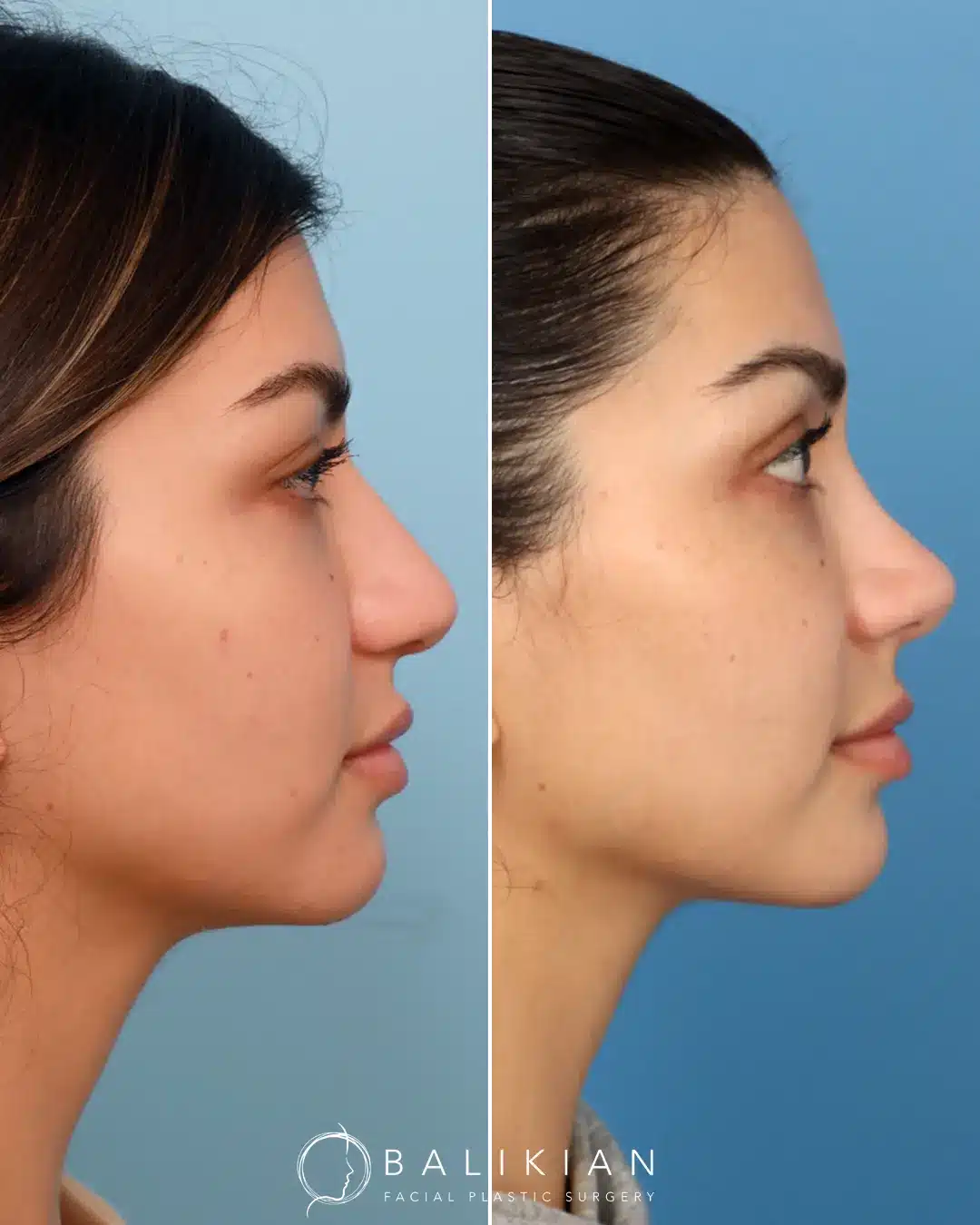 A rhinoplasty that just enhances your natural beauty and features. Dr. Balikian focuses on making your nose fit uniquely to your face and nothing makes him happier than helping his patients achieve their goals to still looking like themselves, but only softer.