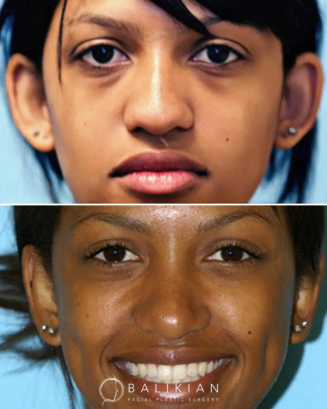 Otoplasty results for African American female showing ear pinning and natural-looking ear symmetry.