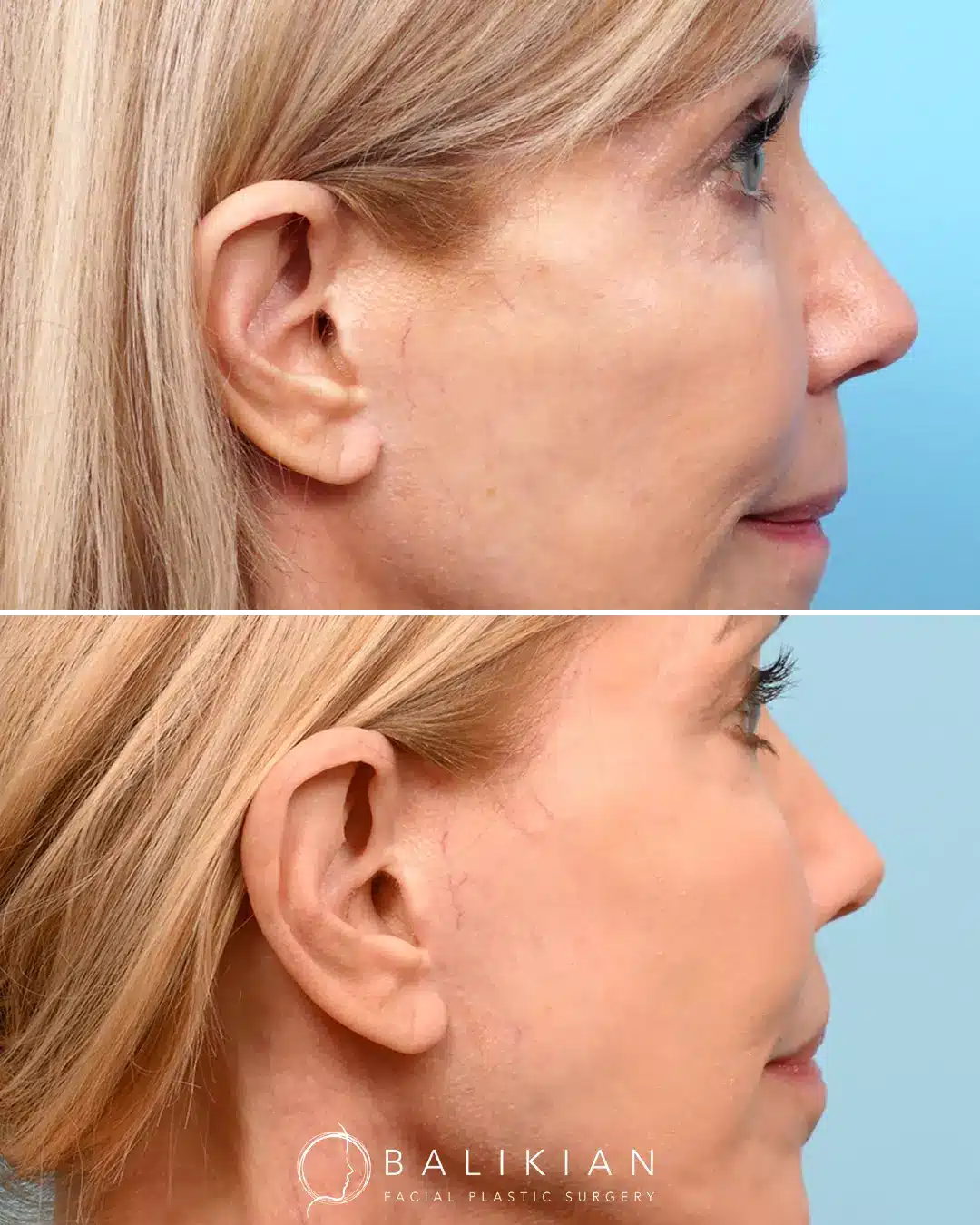 Side view of otoplasty showing natural repositioning of the ear.