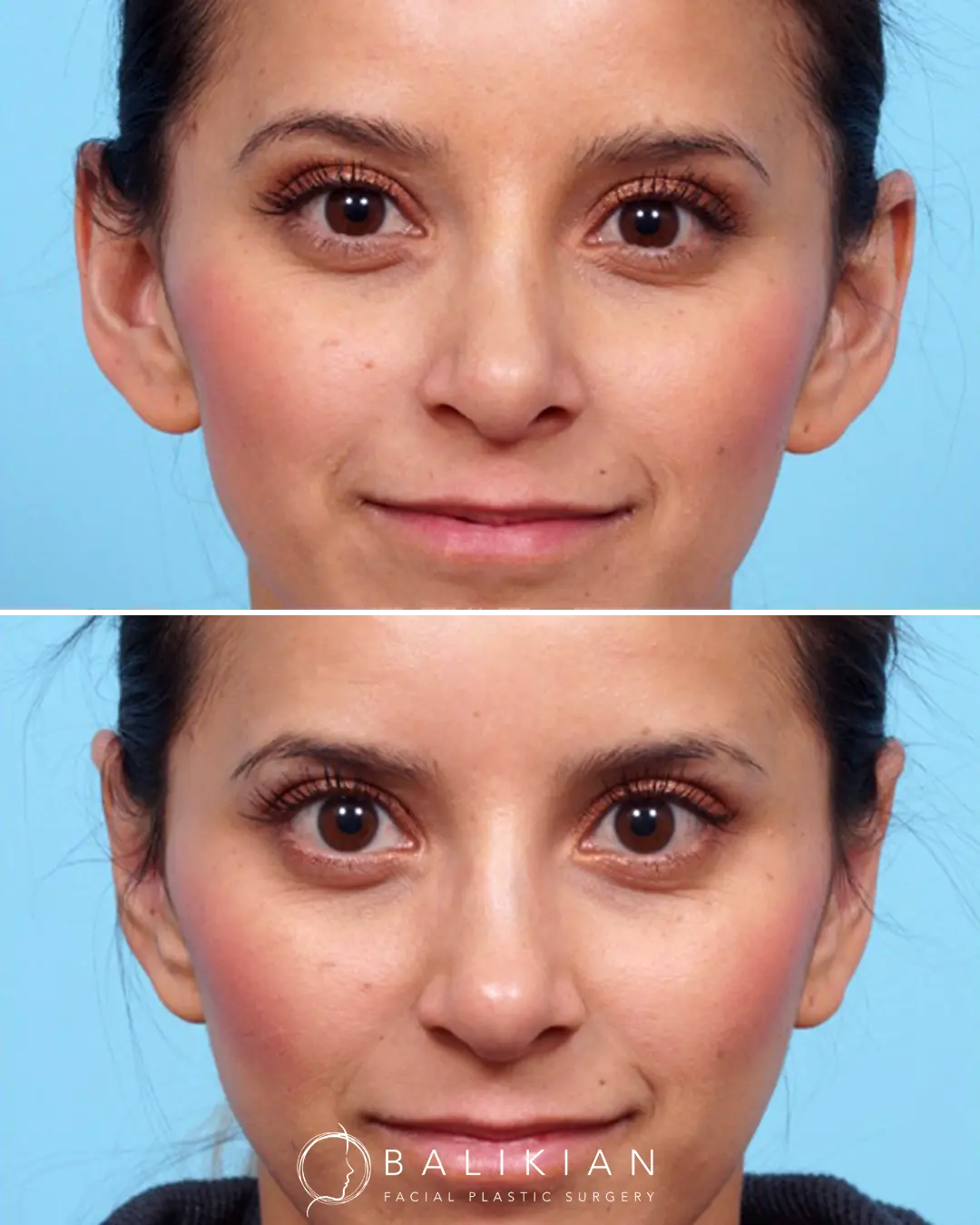 Before and after otoplasty in a young San Diego female patient, showing improved ear shape and placement.