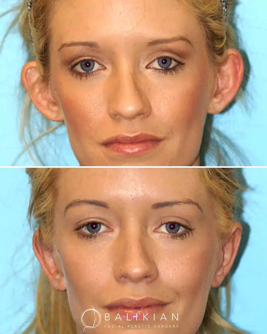 Frontal view of ear pinning otoplasty results, correcting protruding ears for a more balanced facial appearance.