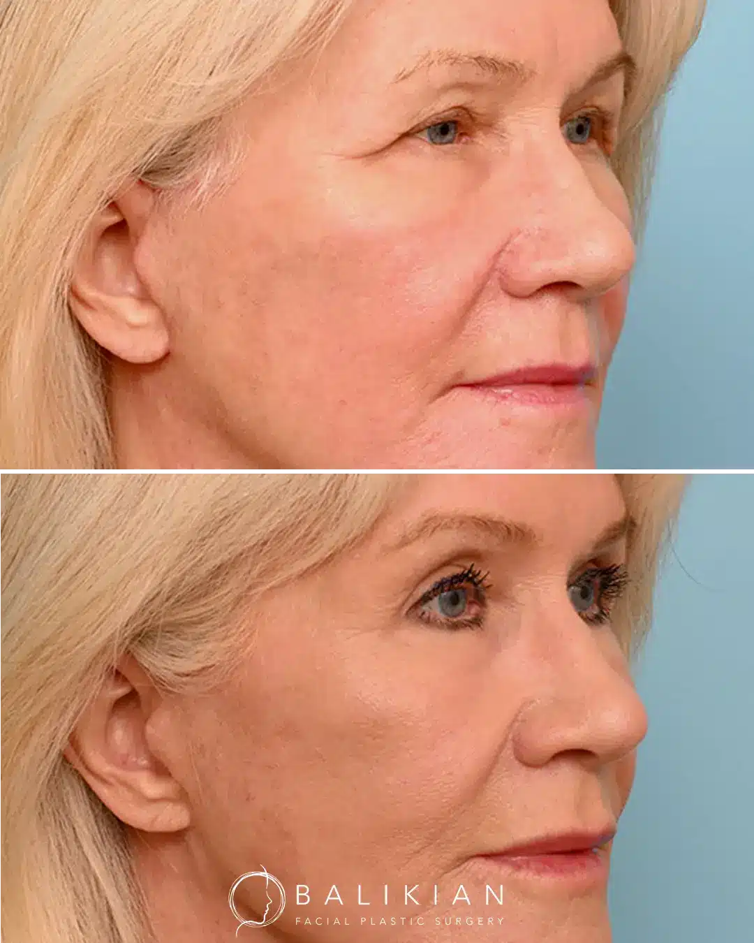 Before and after otoplasty with earlobe reduction showing a more refined, symmetrical ear contour in a female patient.