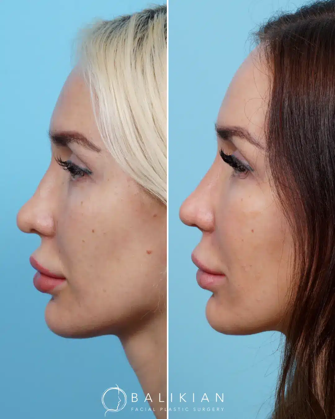 Side view of nose before and after secondary rhinoplasty by Dr. Balikian