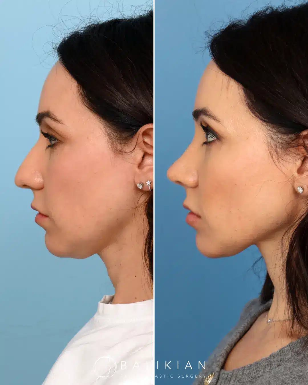 As a surgeon, Dr. Balikian is honored to help his patients align their outer appearance with their inner confidence and vision. Dr. Balikian performed an external rhinoplasty with septoplasty only three months ago. Her swelling will continue to subside over the year.
