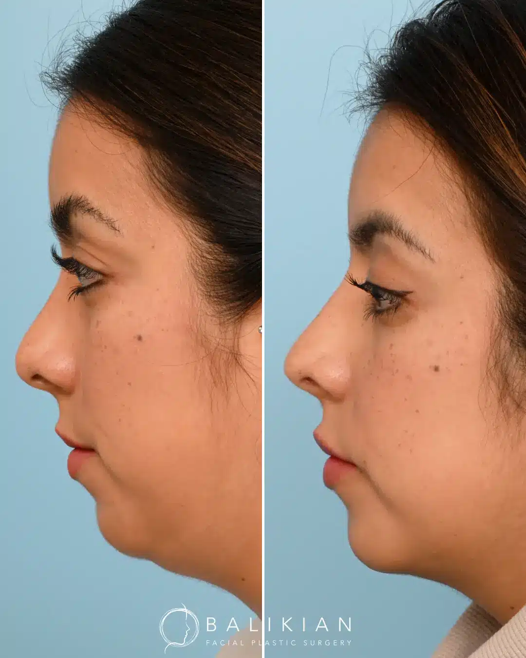 Angled view highlighting nasal refinement after revision rhinoplasty, correcting asymmetries from prior surgery