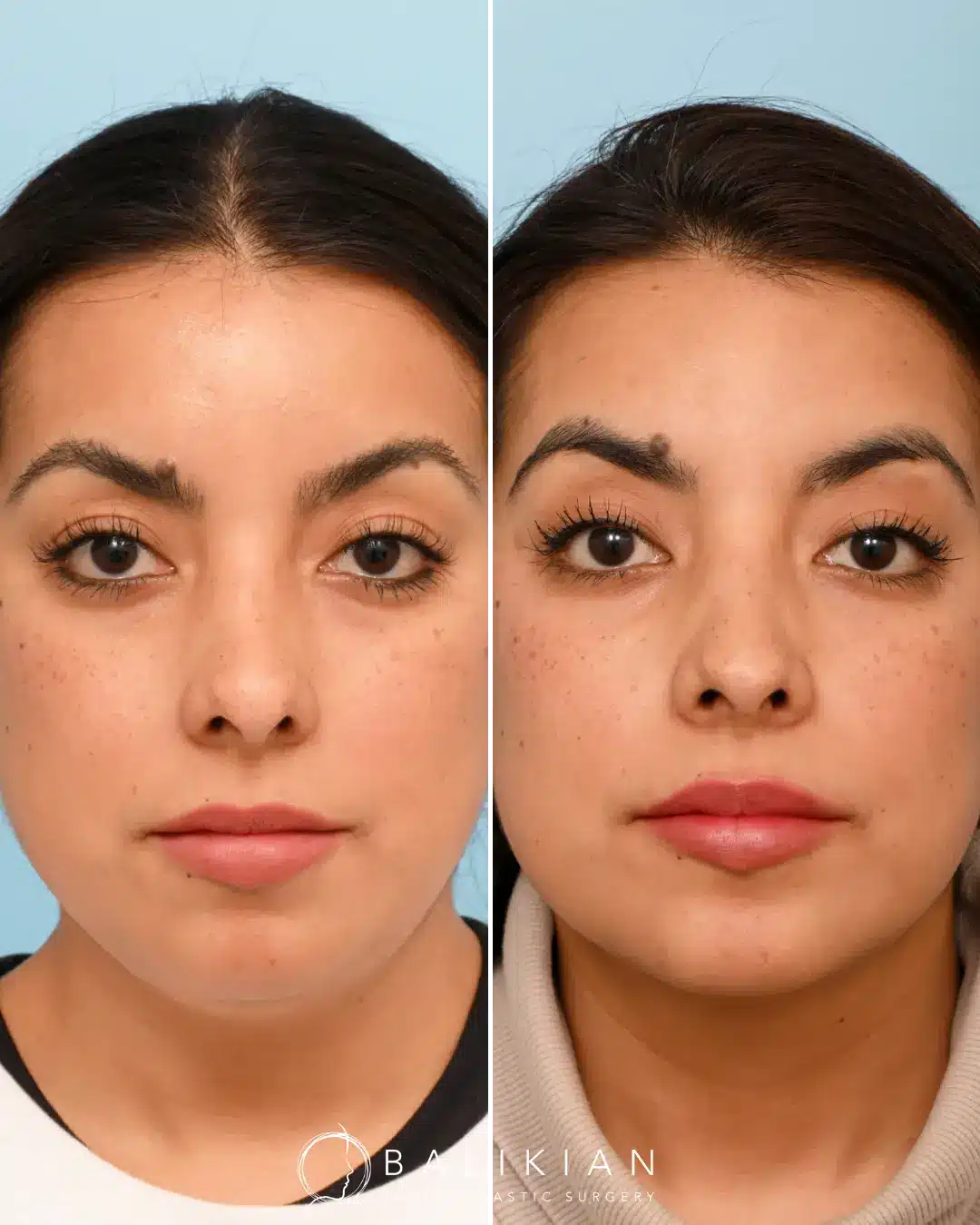 Frontal view showing a more symmetric and structured nasal appearance after expert revision rhinoplasty by Dr. Balikian