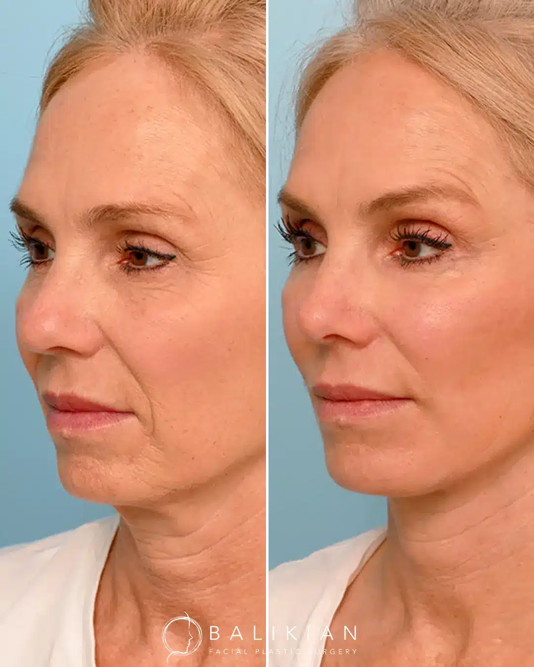 Before and after facial fat transfer showing restored cheek volume