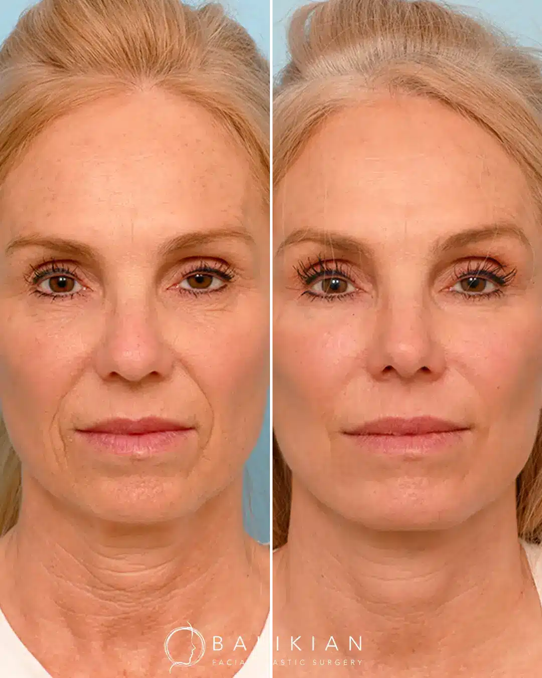 Fat injections in face before and after with smoother under-eye area