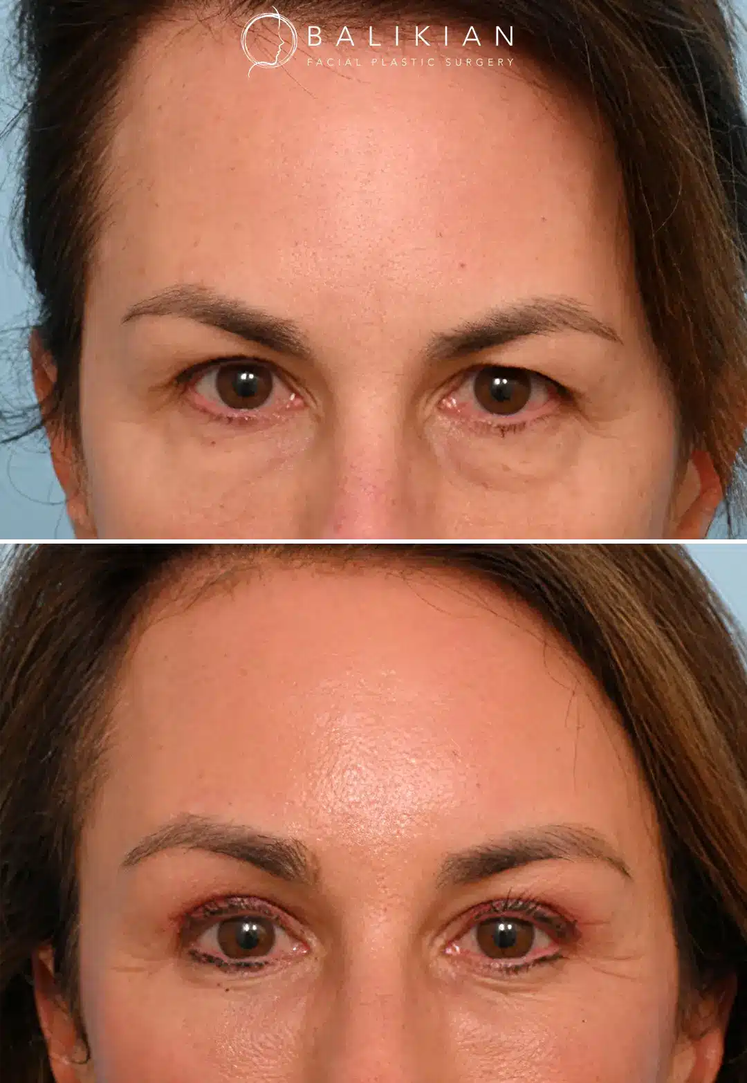 Eyebrow lift before and after featuring brighter eyes and improved brow symmetry.