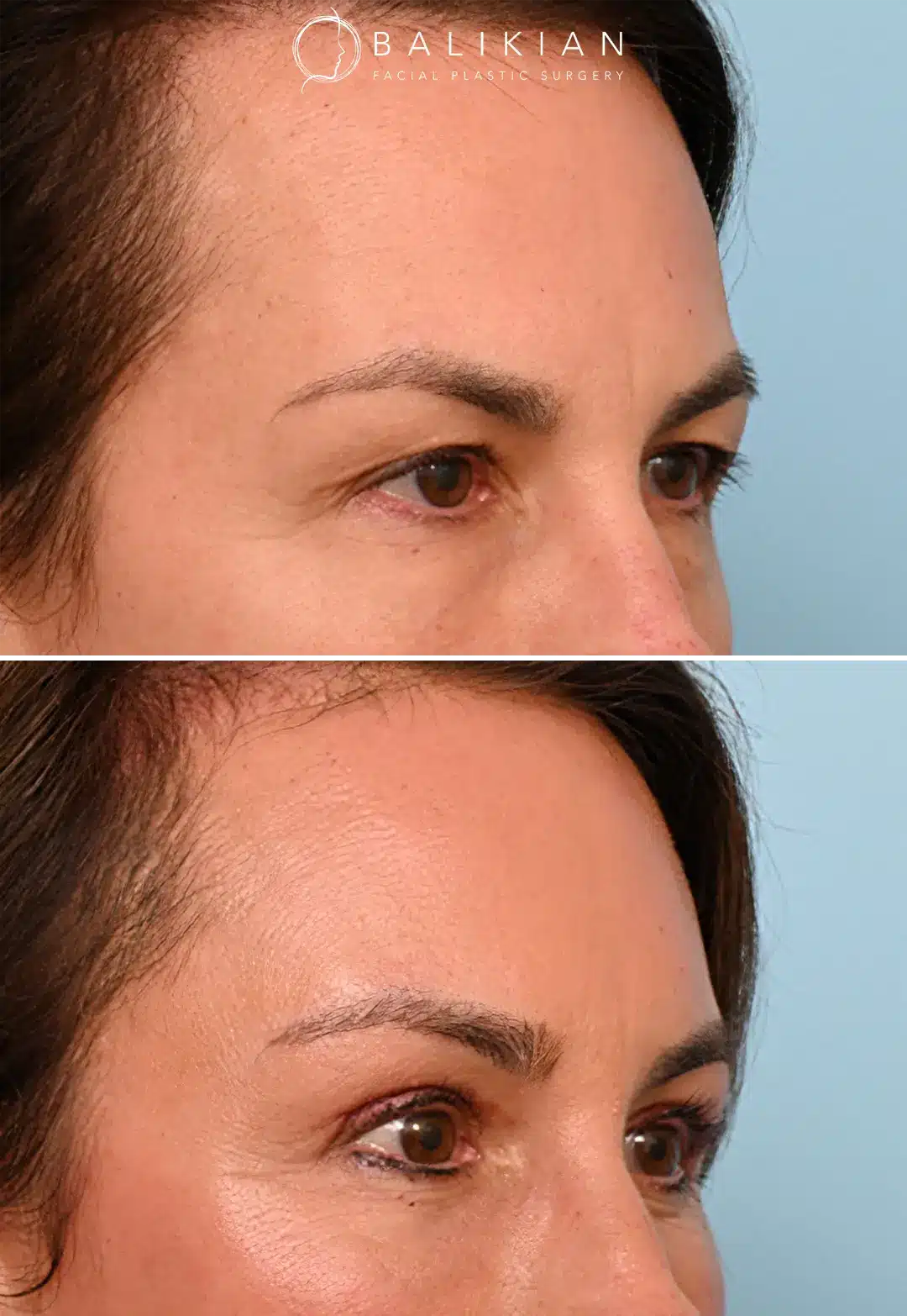 Forehead lift before and after results highlighting reduced wrinkles and elevated brows.
