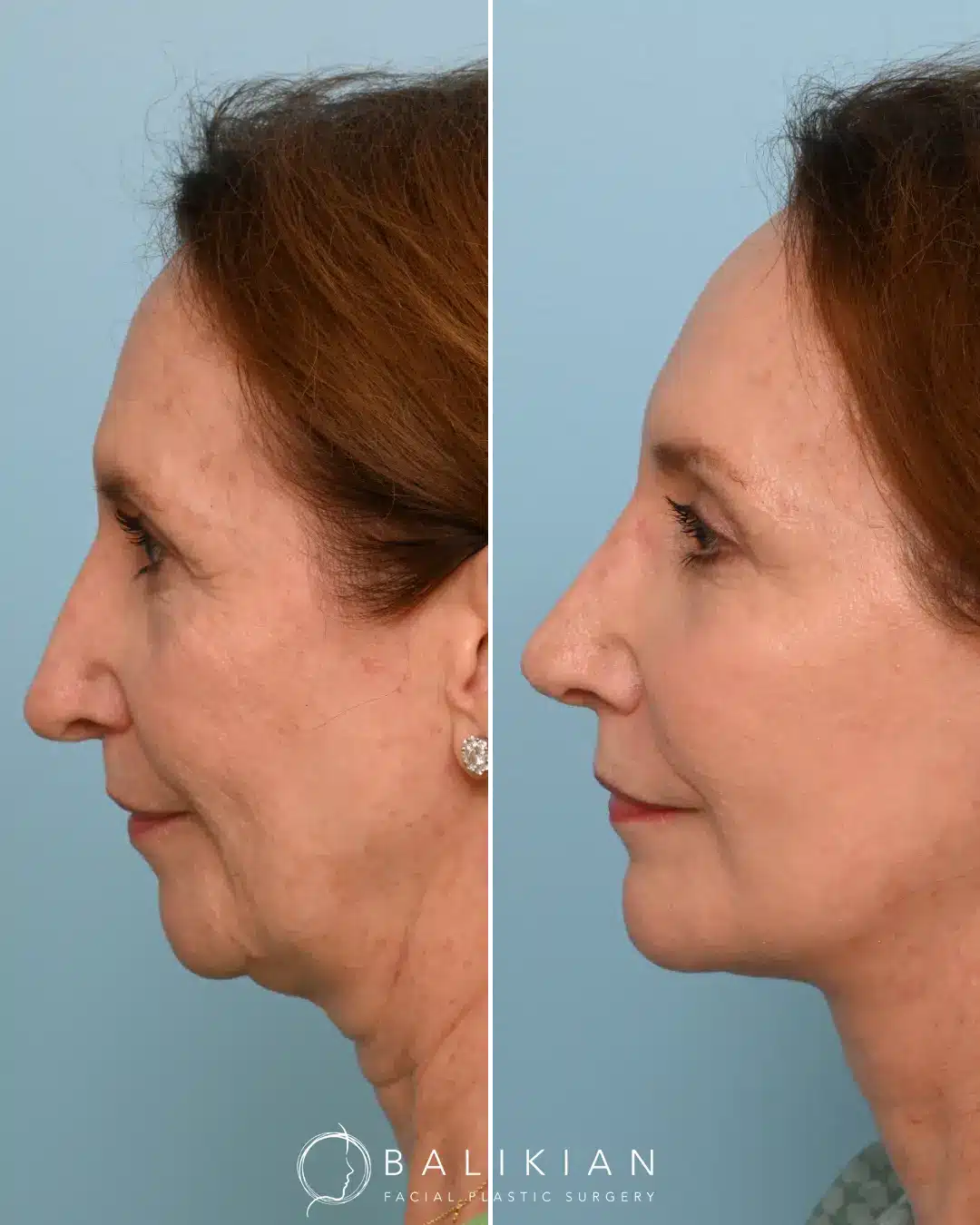 Subtle transformation from revision rhinoplasty showing lifted nasal tip