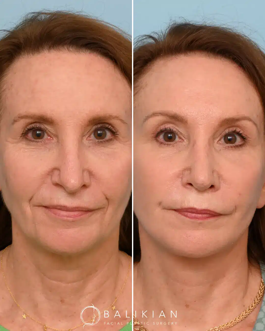 Before and after photos of a patient who underwent rhinoplasty revision