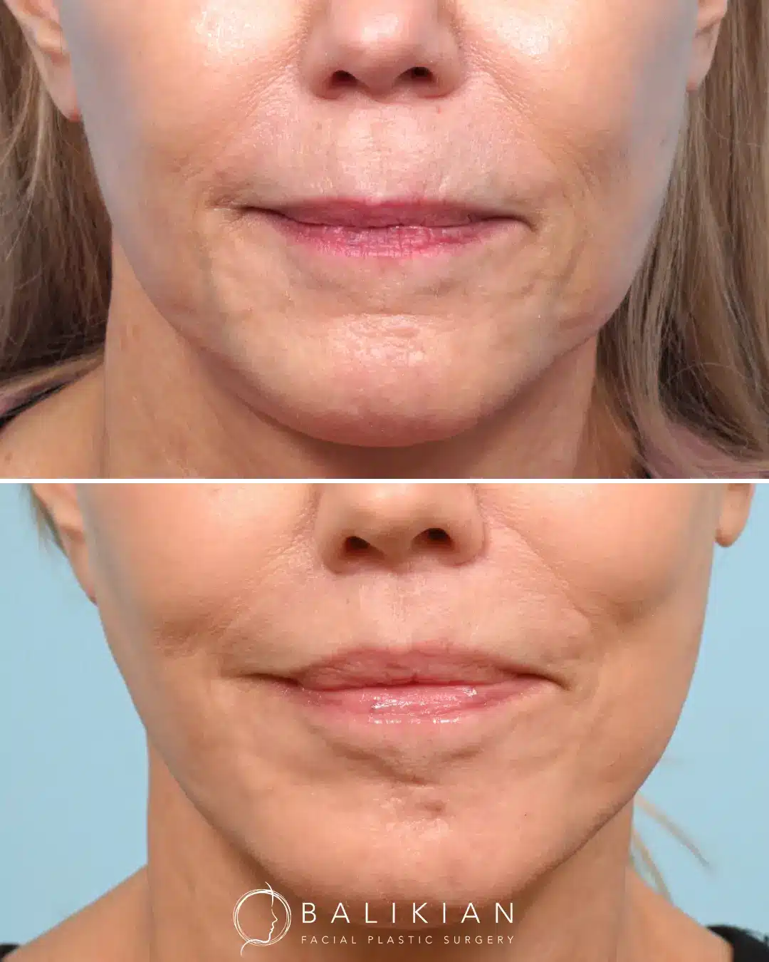This frontal view shows a refined transformation following an upper lip lift. The distance between the nose and upper lip has been shortened, enhancing lip definition and creating a fuller, more youthful appearance, all while maintaining balance with the lower face.