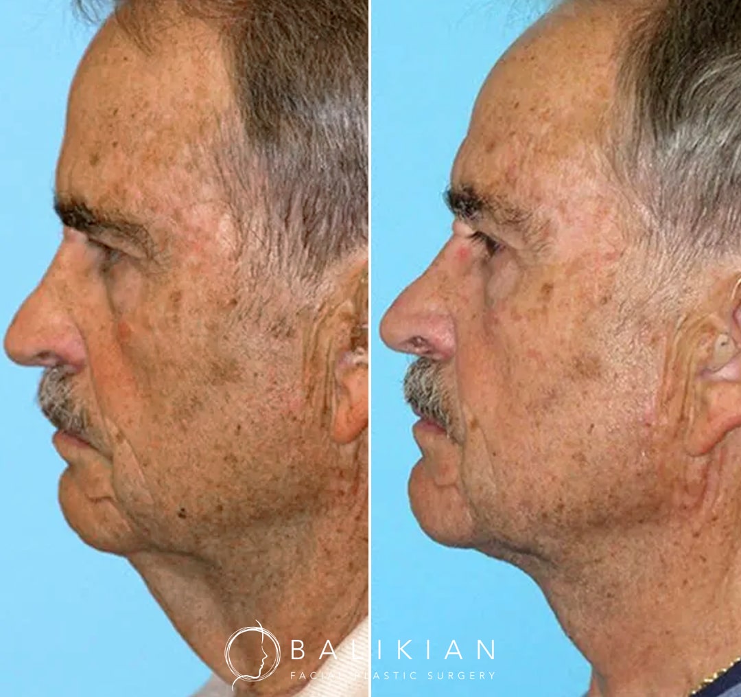 Improved neckline in older male patient following direct neck skin removal and muscle tightening for a smoother, firmer look.