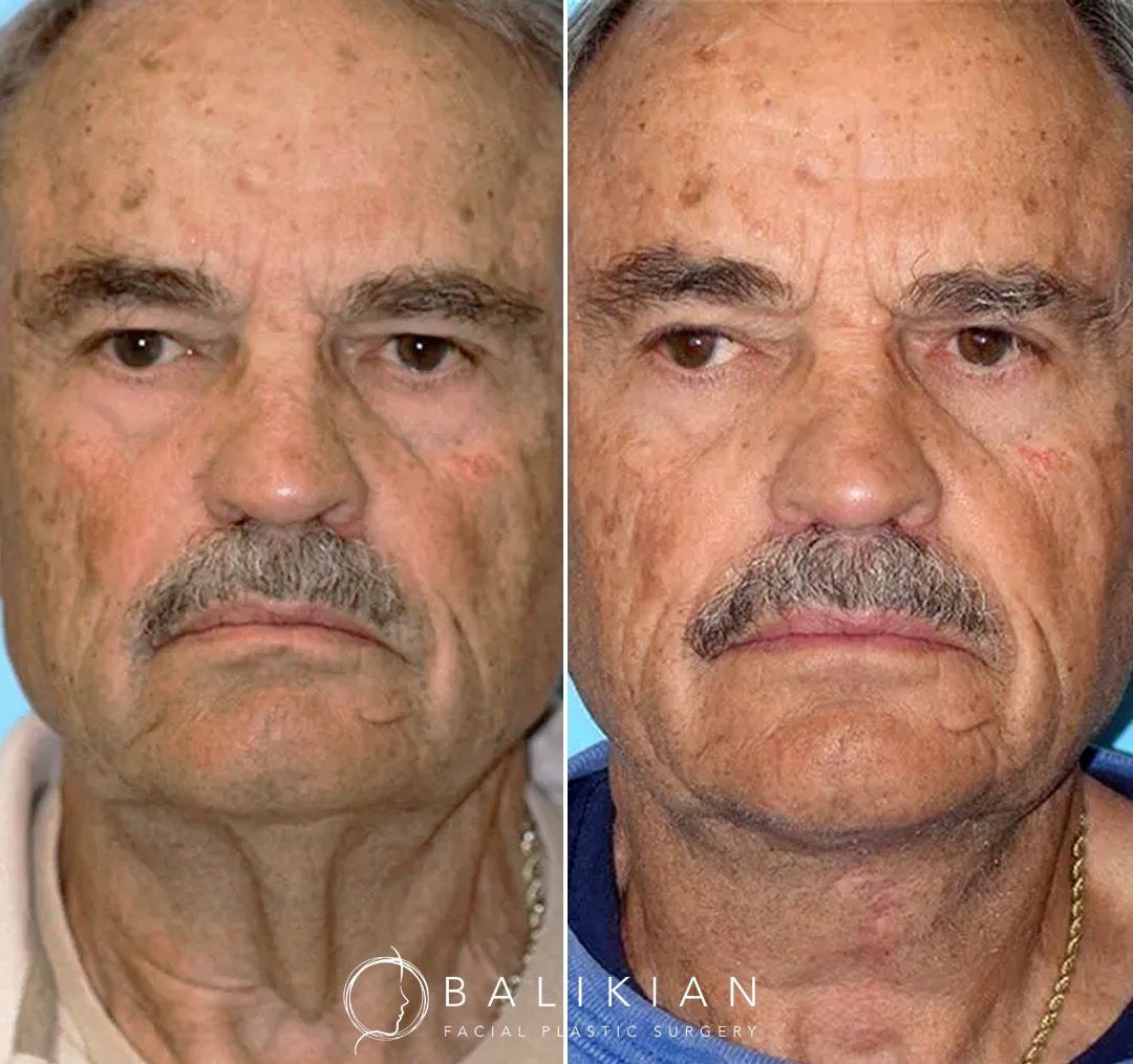 Before and after results showing removal of “turkey neck” with minimal downtime, allowing comfortable shirt and tie wear.