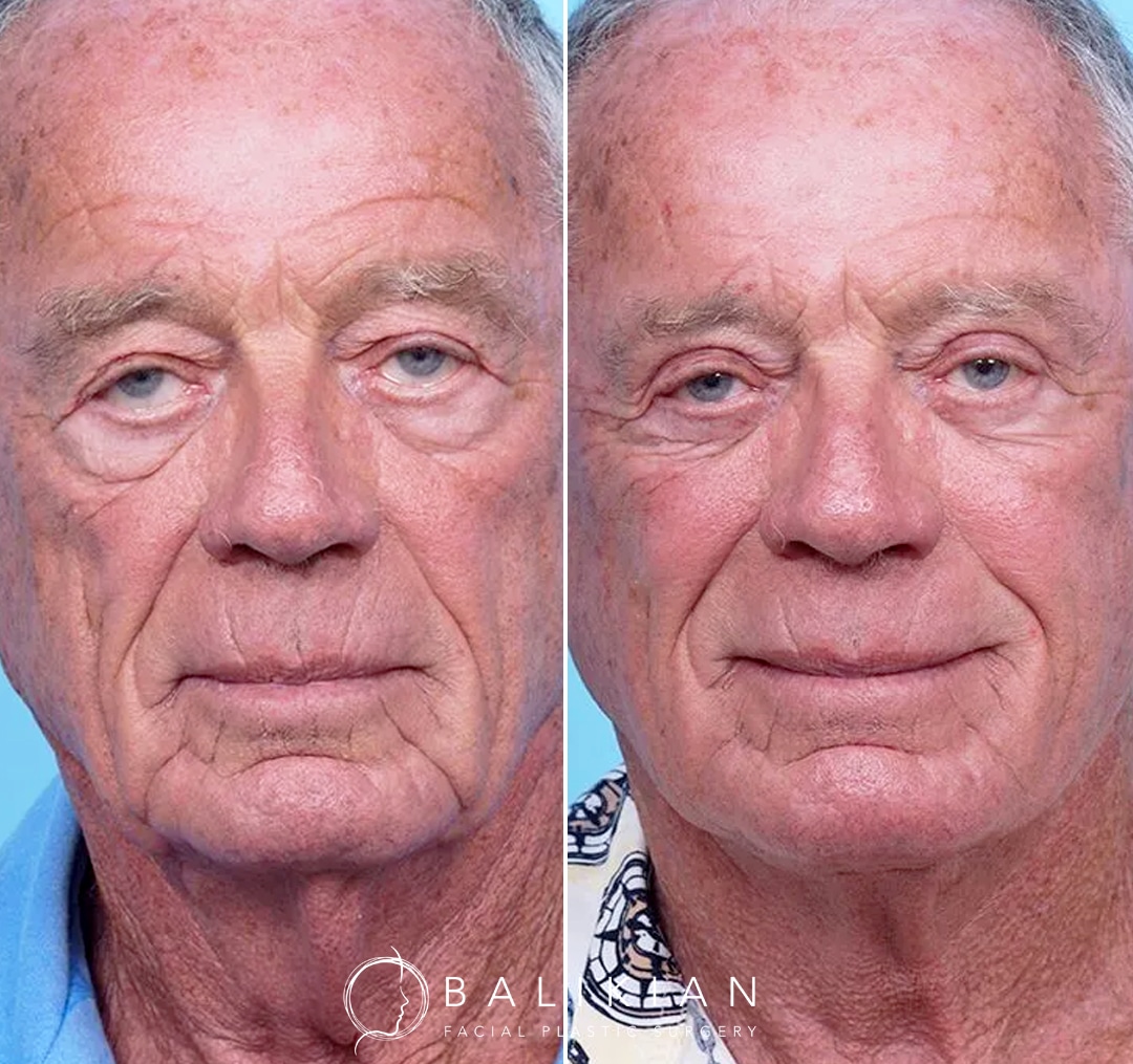Full facial rejuvenation in male patient after facelift and eyelid surgery, maintaining balance and masculinity