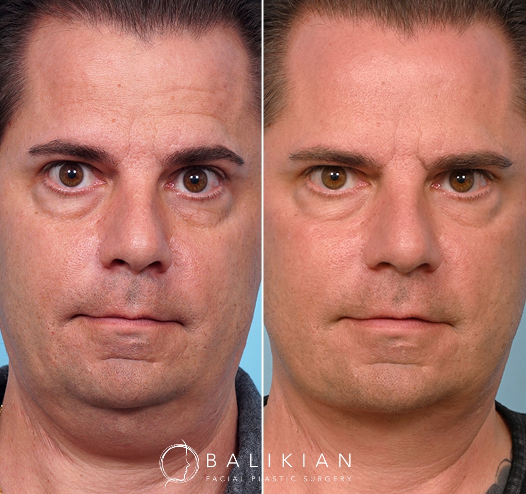 This patient in his mid-40’s was bothered by heavy jowling in the neck. Dr. Balikian performed a face and neck lift 6 months ago. The patient will continue to heal over the next 6 months.