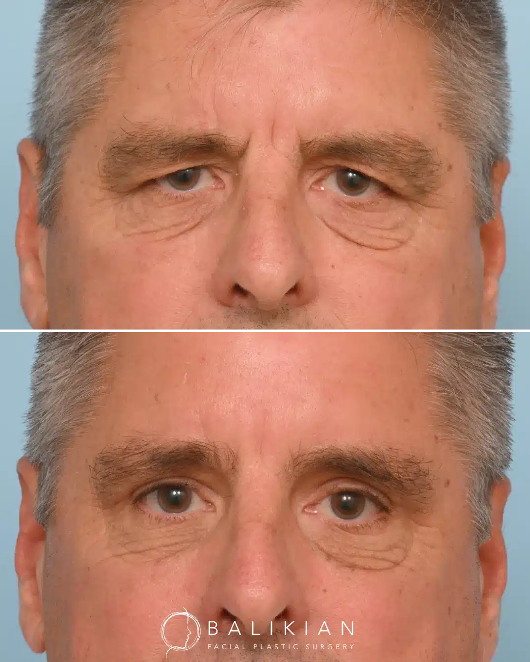Before and after front view of male patient after brow lift surgery, showing lifted brows and smoother forehead