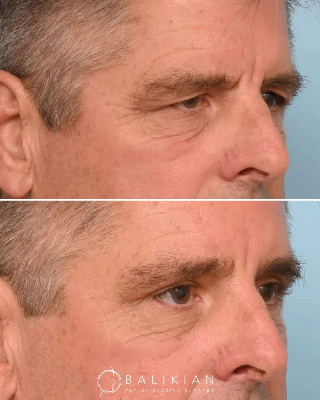 Angled before and after photo of male patient after brow lift, showing reduced forehead lines and improved brow position
