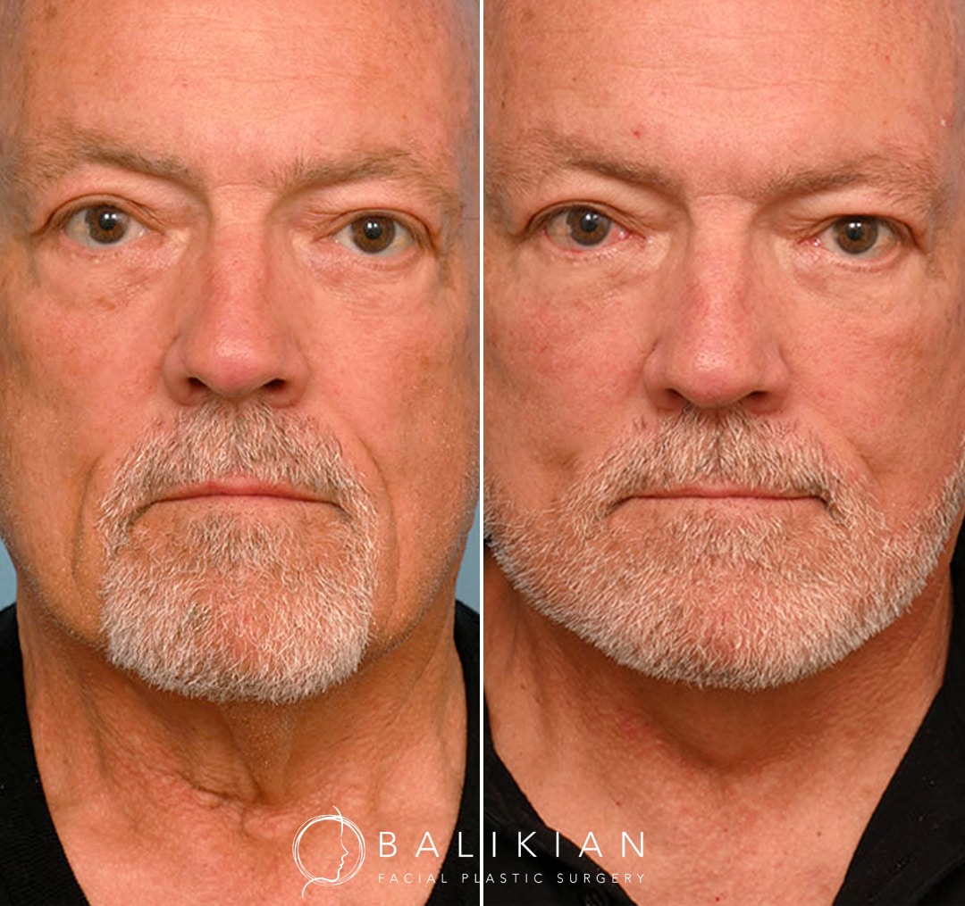 Natural-looking results in male patient after facelift, deep neck lift, and eyelid rejuvenation, preserving masculine features