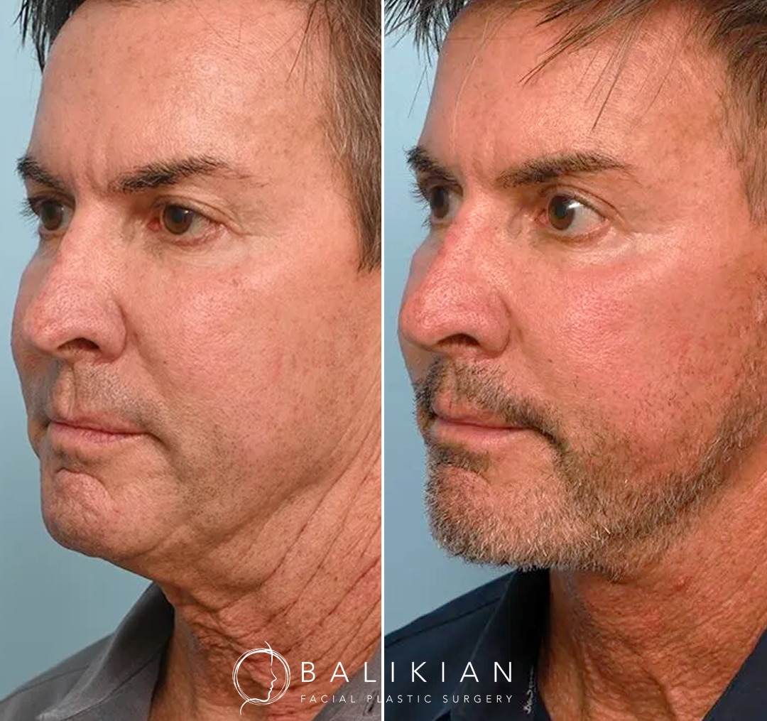 Before and after of male patient showing sharper neckline and lifted lower face after deep plane facelift and neck contouring by Dr. Balikian