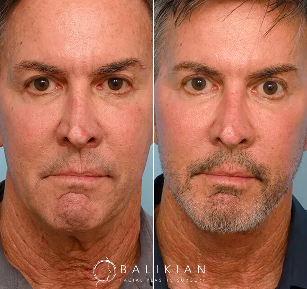 Male patient looking more youthful and energetic after customized face and neck lift surgery with deep neck sculpting