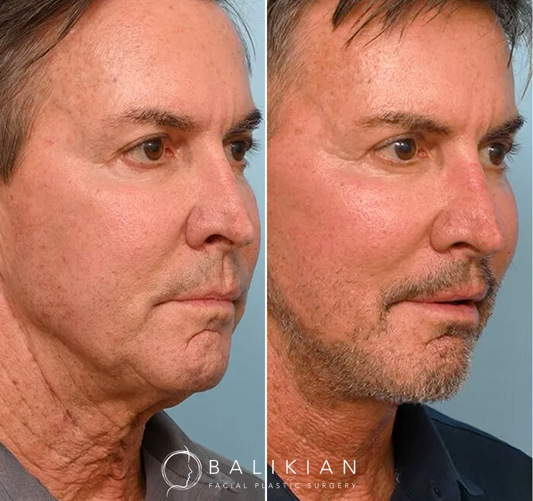 Transformation highlighting reduced neck fullness and improved jawline in a patient who felt young at heart but looked tired